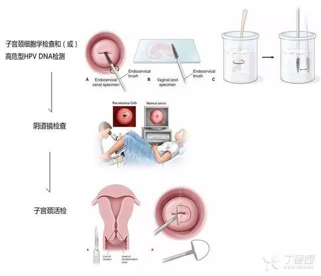 宫颈细胞学检查及 hpv 筛查异常?10 张流程图全搞定