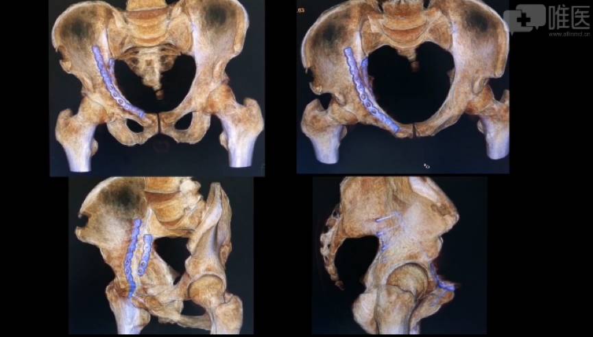 规范化手术获奖作品 | 伴有"海鸥征"表现的髋臼顶压缩性骨折的手术