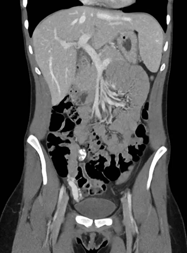 腹部 ct 示右下腹钙化灶