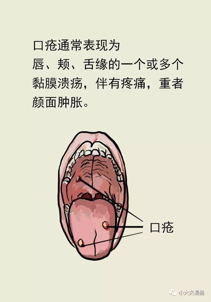 反复口腔溃疡需重视,看看为什么?