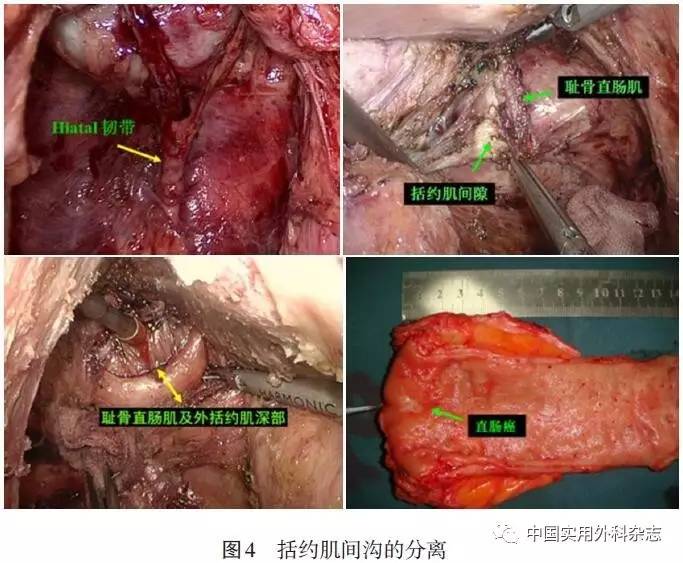 术式讨论|低位直肠癌行腹腔镜内括约肌切除术技巧与