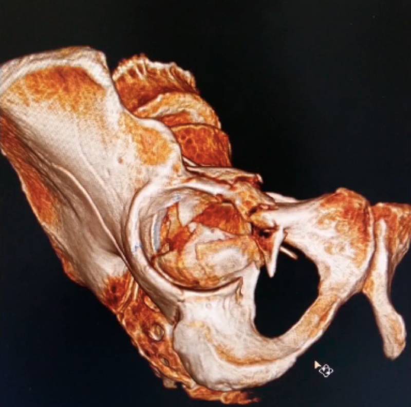 规范化手术获奖作品 | 伴有"海鸥征"表现的髋臼顶压缩性骨折的手术