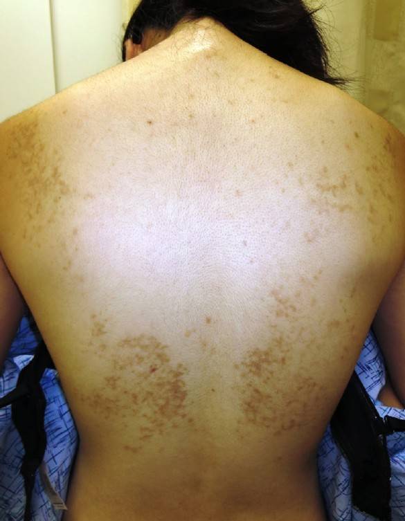 图 1 一例 18 岁韩国女性背部突发性瘙痒性红色荨麻疹样丘疹-斑块伴