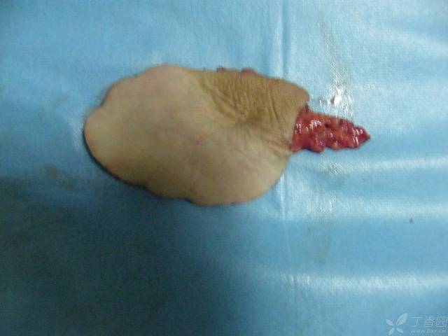 全程手术图片:虎口挛缩,瘢痕切除,游离皮瓣修复
