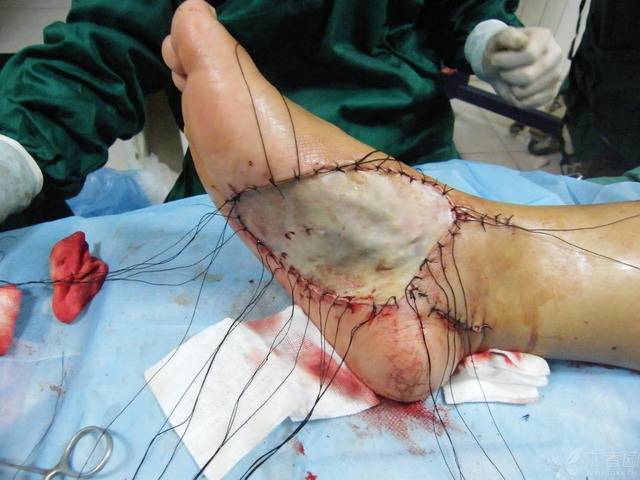 全程手术图片:虎口挛缩,瘢痕切除,游离皮瓣修复
