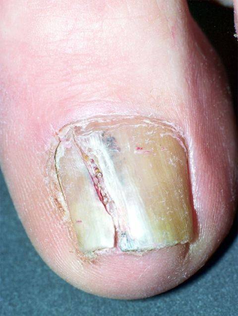 临床释疑:甲母痣的特征及处理