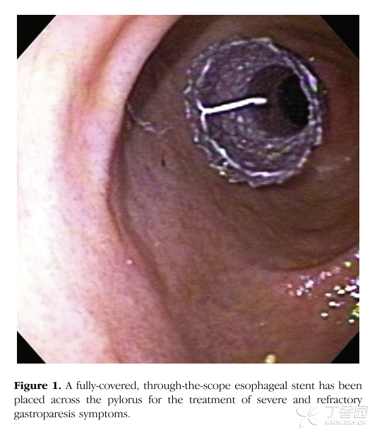 通过内镜在幽门部放置食管支架来缓解严重的难治性胃轻瘫症状