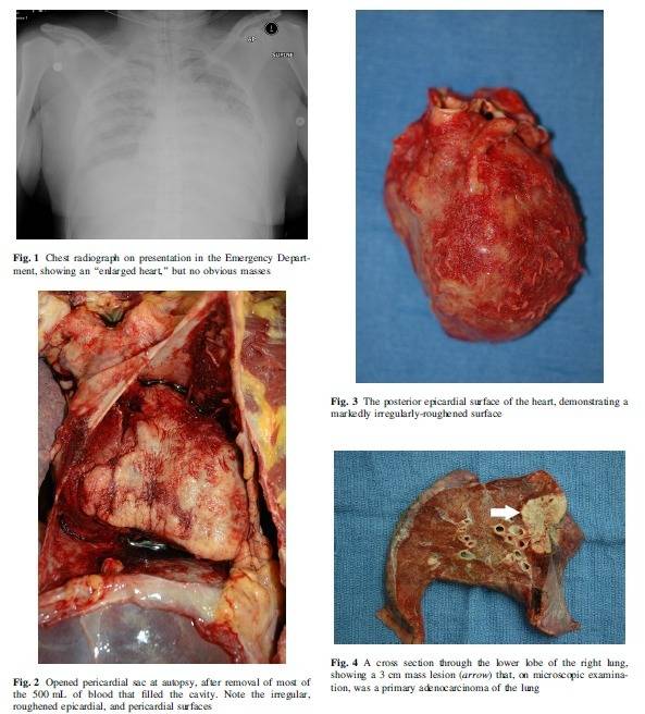 猝死于肺癌转移导致的心包填塞一例