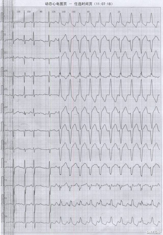 动态心电图2