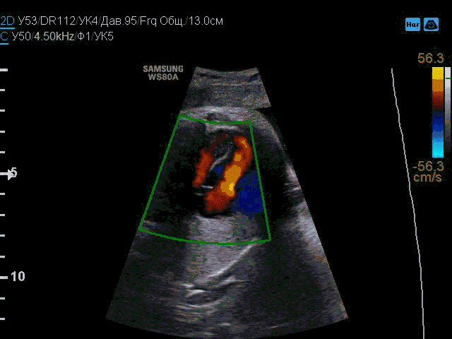 医学新闻 正文  图 1 二维图像示心动周期不同阶段室间隔膜部(尤其近