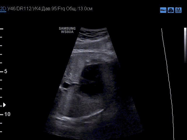 医学新闻 正文  图 1 二维图像示心动周期不同阶段室间隔膜部(尤其近