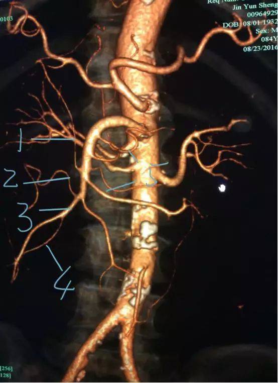 图 3 为腹主动脉分支肠系膜上动脉.