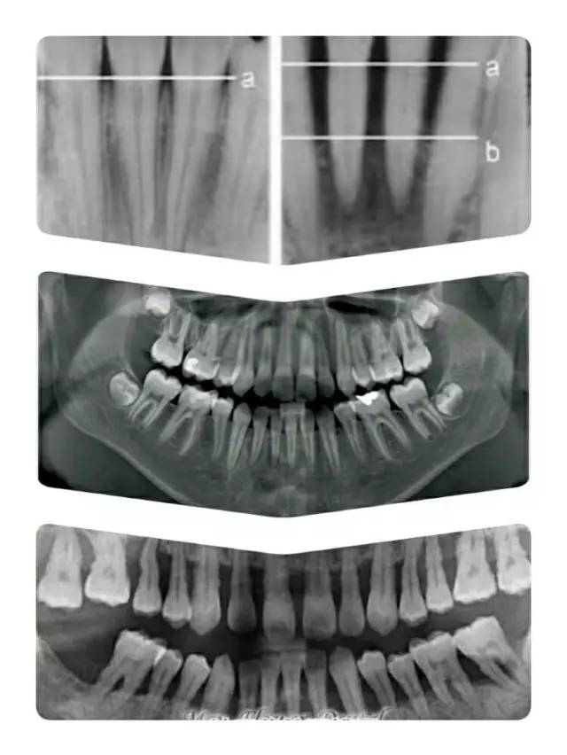在上图x光显示下,牙槽骨从正常水平 a 线萎缩到了b 线(中图为