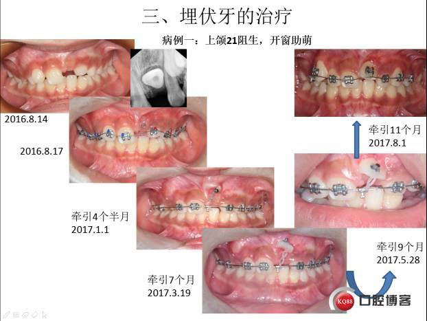 阻生牙的开窗助萌