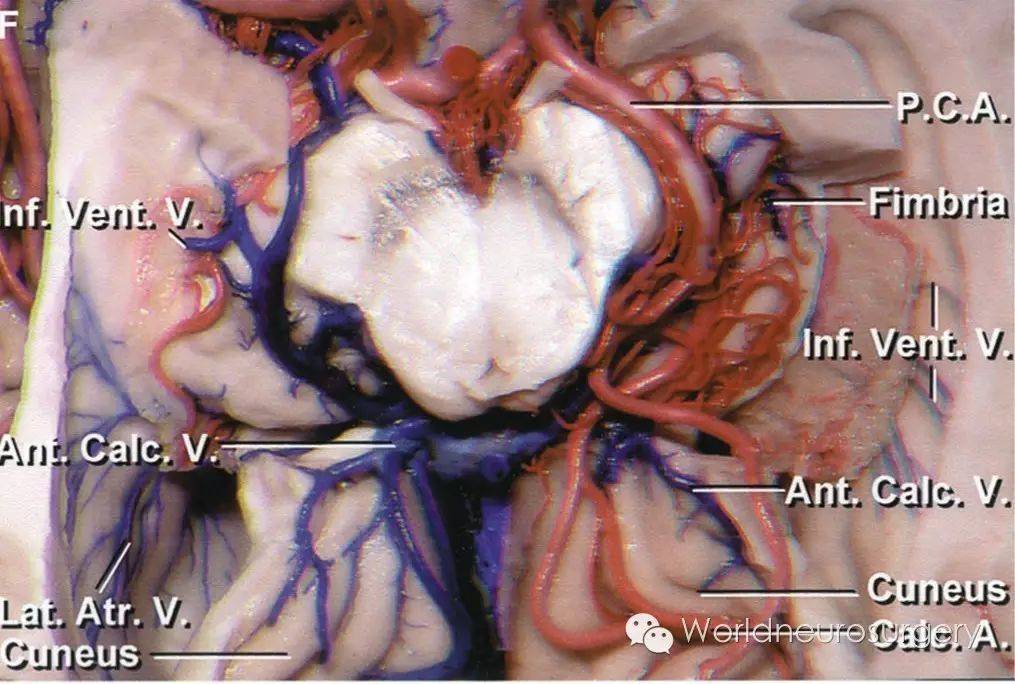 rhoton解剖系列精选一大脑静脉显微解剖彩图展