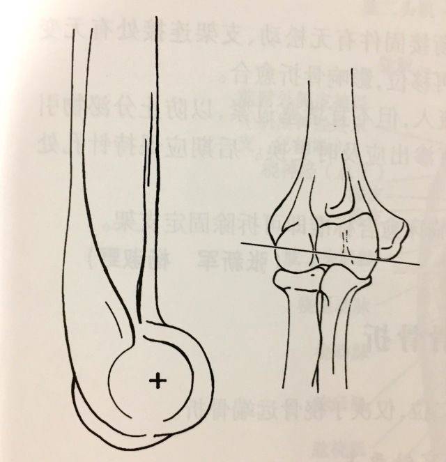 荐读| 肱骨远端骨折穿针外固定技术