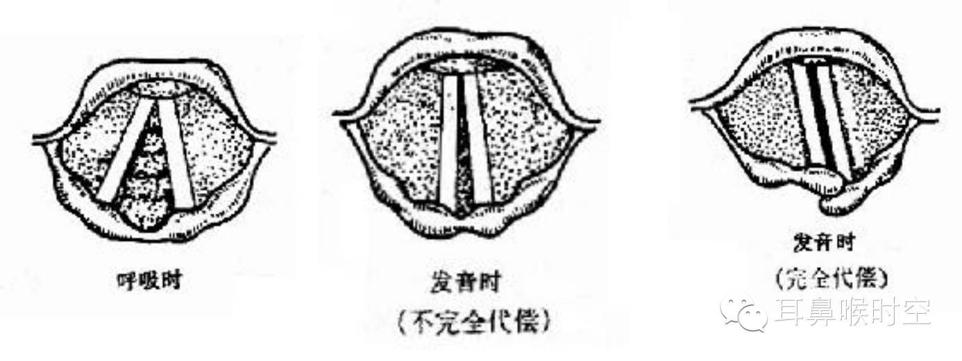 医学新闻 正文  (四)双侧完全性麻痹:两侧声带居旁中位,既不能闭合,也