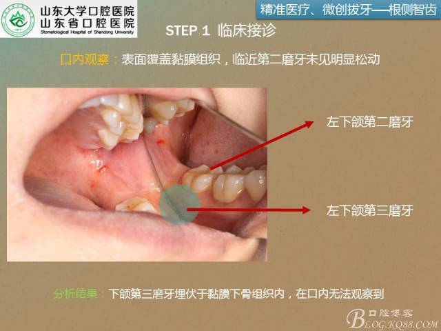 疑难复杂牙拔除系列--第一弹:第二磨牙根侧阻生牙--陈国昆