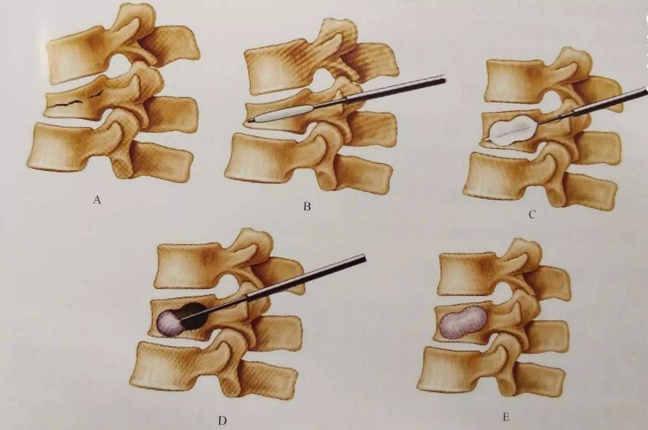 骨科基础 | 经皮后凸椎体成形术