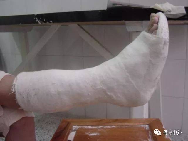 医学新闻 正文  3,短腿石膏管型(托):腓骨头下两横指,跖骨颈,鞋底超过