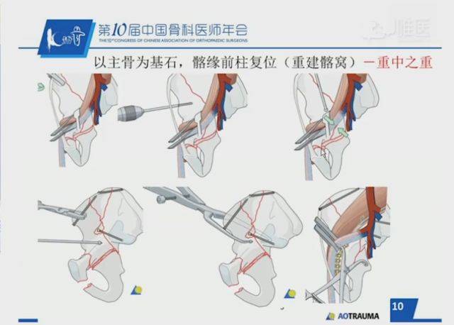 髂腹沟入路治疗双柱骨折