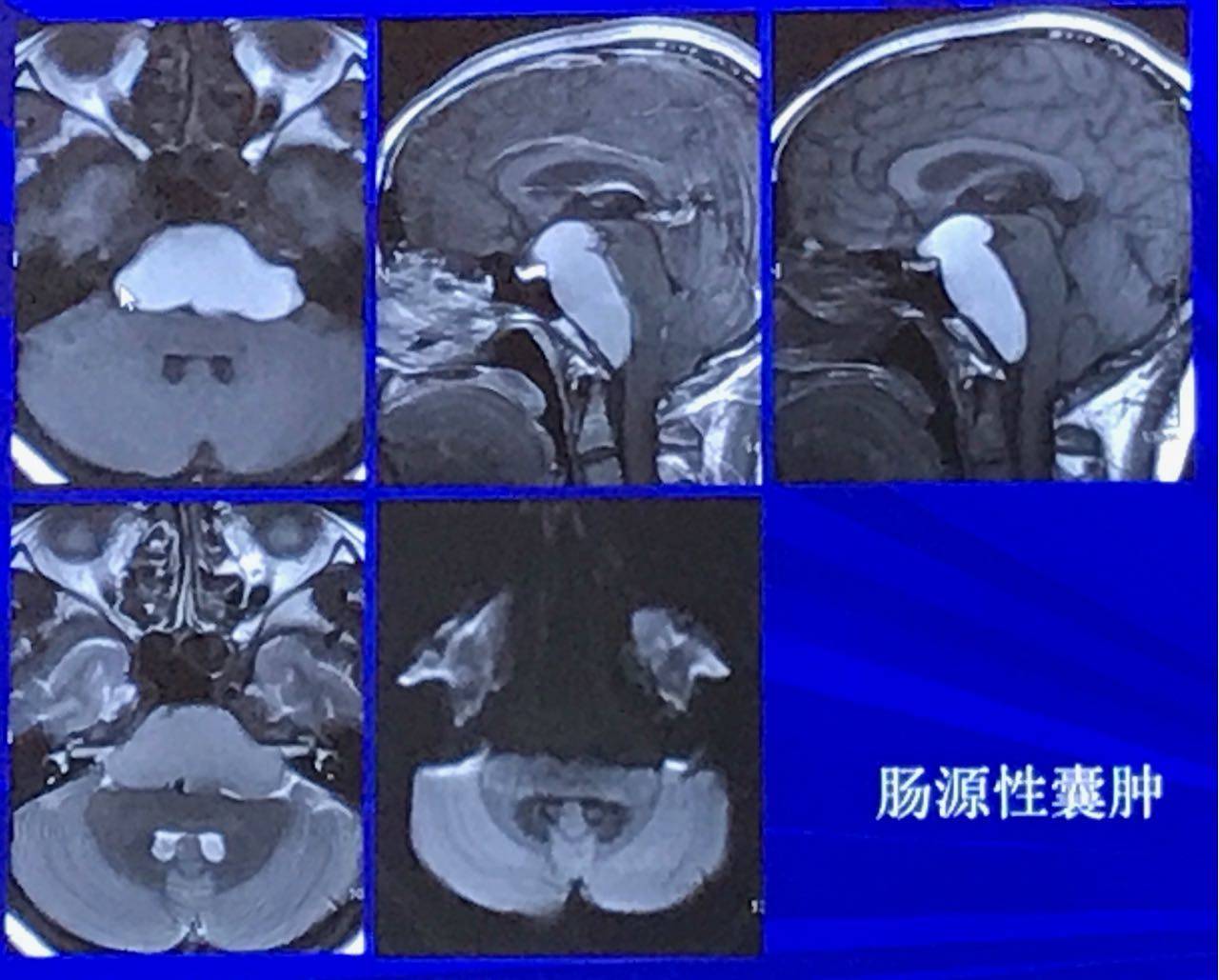 肠源性囊肿