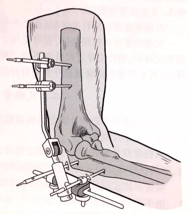 特殊病例,则可采用半环形支架,肱骨远端骨折病例应用跨肘关节外固定器