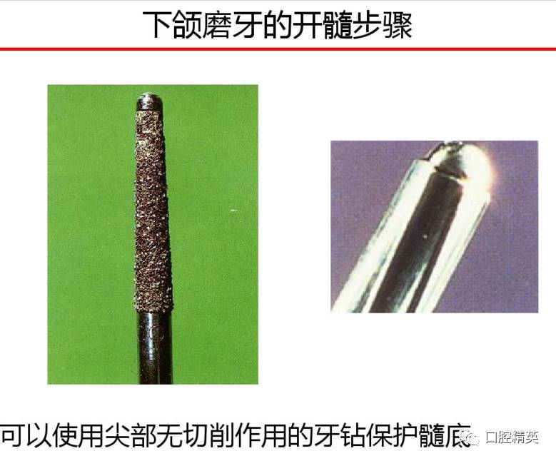 下颌磨牙髓腔解剖及开髓