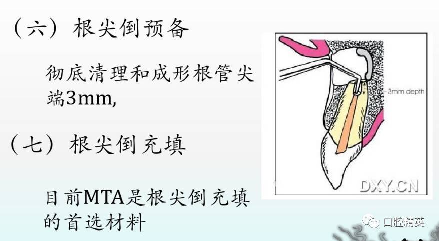 根尖切除术