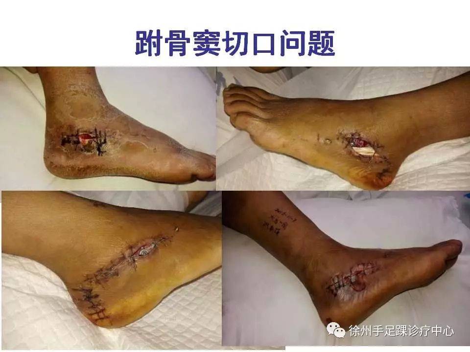 跟骨骨折的并发症有哪些?怎么处理?