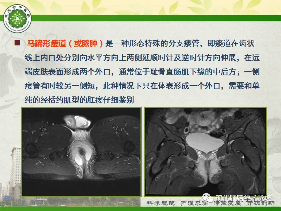 并能对肛瘘患者术后遗漏的细心内瘘口,细心瘘管及假性愈合进行诊断