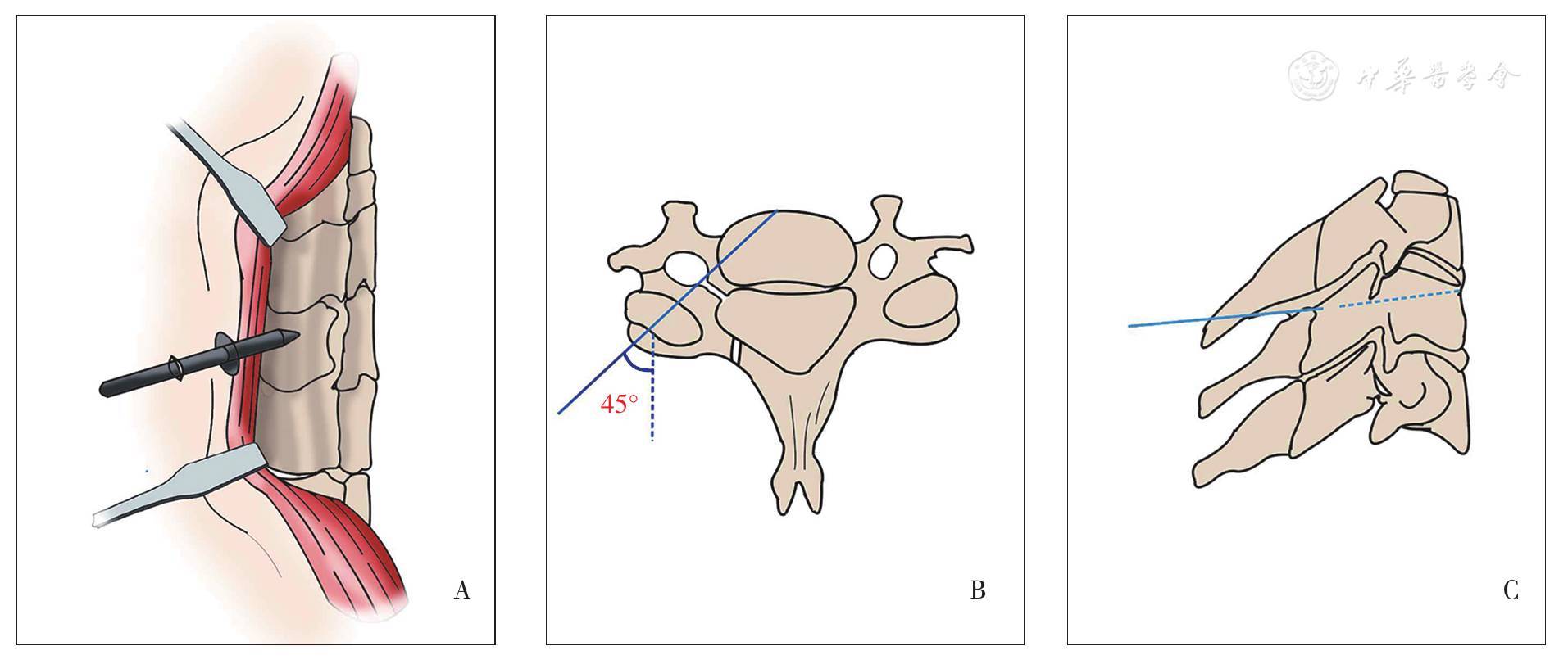 下颈椎后路椎弓根螺钉置钉方法的研究进展