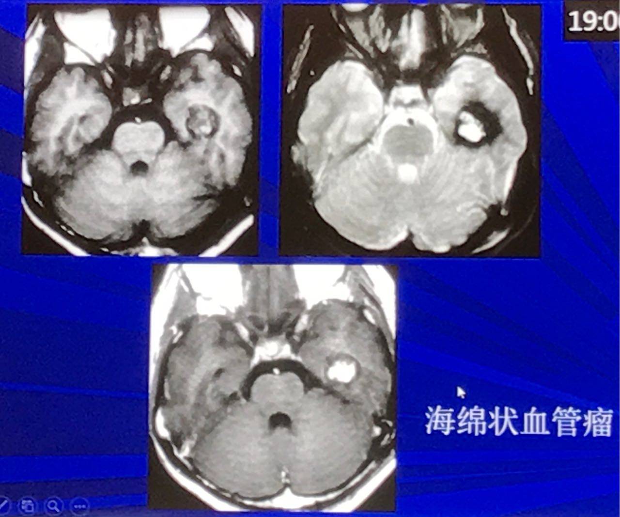海绵状血管瘤