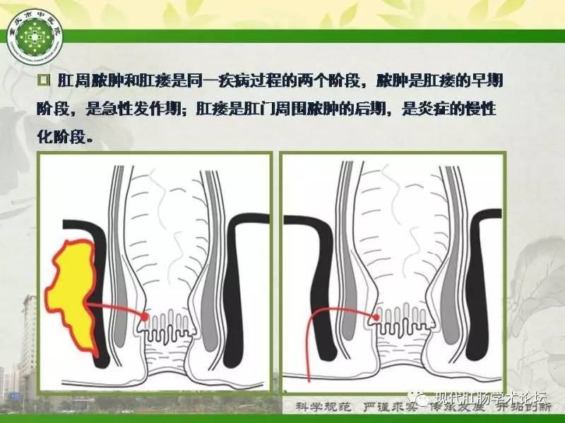 瘘口及肛周脓肿与肛门周围肌肉,肌间隙的位置做出准确判断,并能对肛瘘