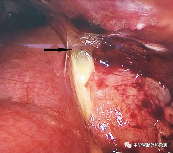 再次手术腹腔镜探查所见吻合口瘘情况(箭头所指为瘘口处)