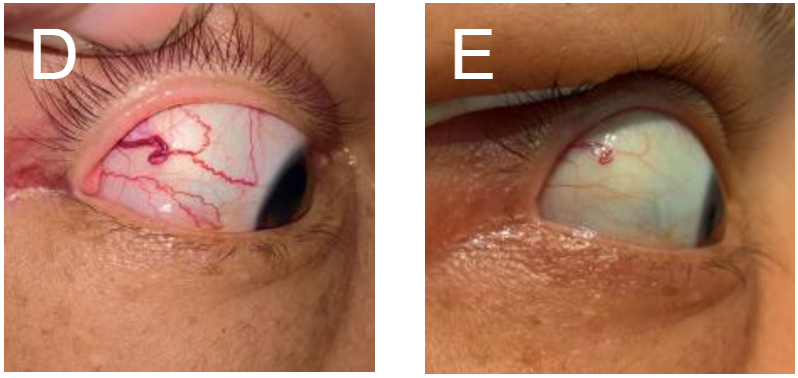 静脉血管内治疗前(d图)及治疗后(e图)眼科检查示巩膜静脉充盈正常