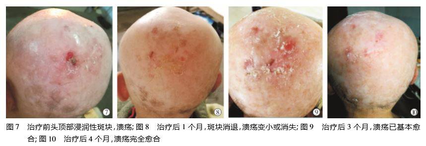 阿维a 治疗头皮鳞状细胞癌1 例