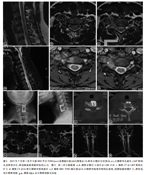 颈椎椎管外脊膜瘤合并颈椎骨质破坏1例