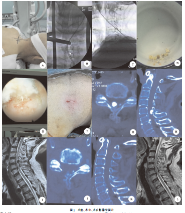 颈椎内镜治疗颈椎黄韧带钙化并颈椎管狭窄症1例