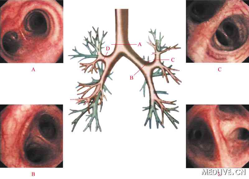 纤维支气管镜下表现