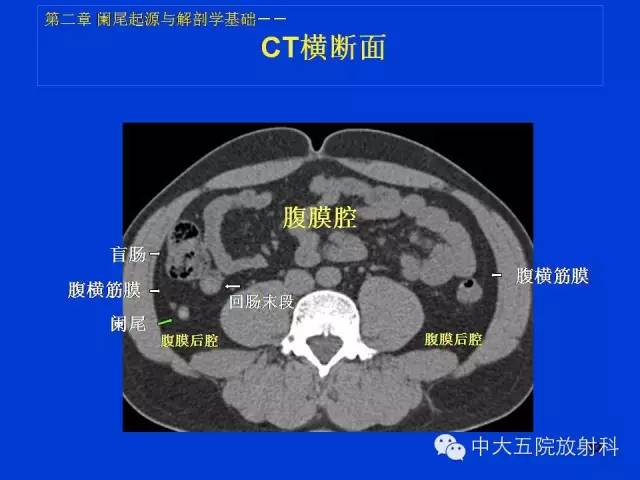 全面讲解 | 正常阑尾和阑尾炎的ct表现