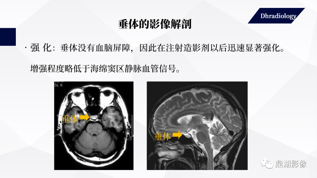 垂体瘤影像诊断详解