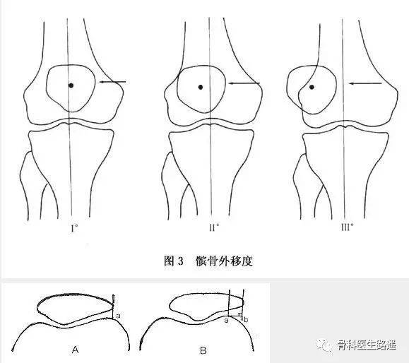 「髌骨软化」这病,99% 的人都误解了