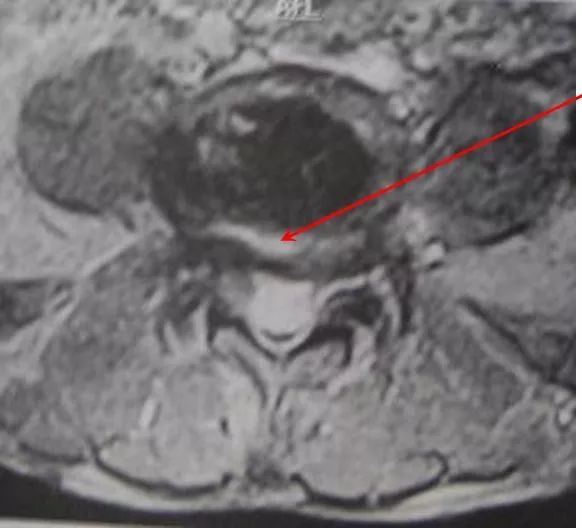 腰椎滑脱的影像学表现及治疗全在这里了