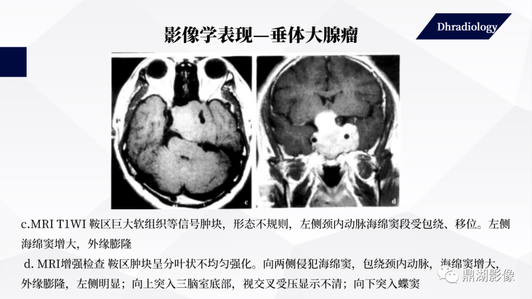 垂体瘤影像诊断详解