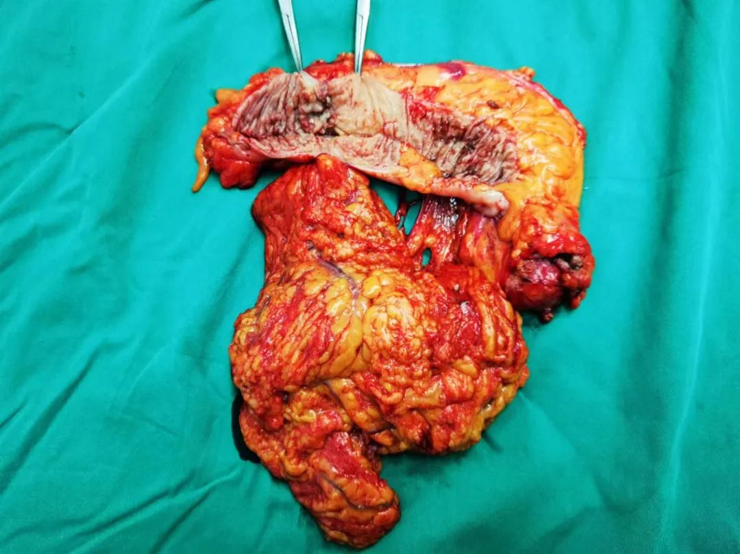 结肠癌术前免疫治疗病例分享