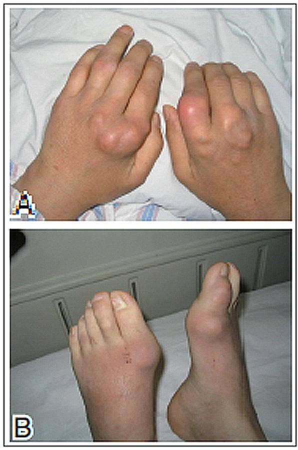 掌指关节,指间关节(a),第一跖趾关节(b)均明显变形,多个痛风石