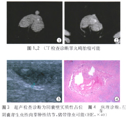 病例:小儿罕见阴囊绦虫病一例