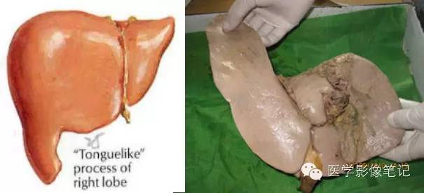 利德尔叶(riedel's lobe 肝的右下部向下如舌状突出生长的舌叶.