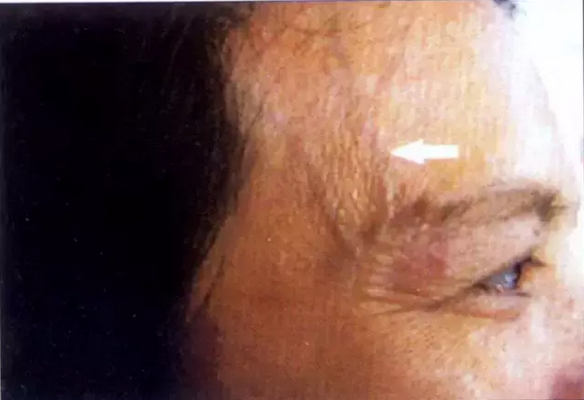 额头呈现青筋:表示可能患有甲状腺机能亢进,糖尿病.